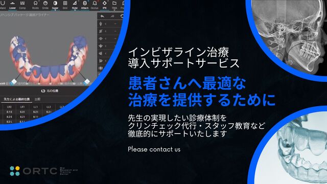 アライナー矯正サポートのイメージ