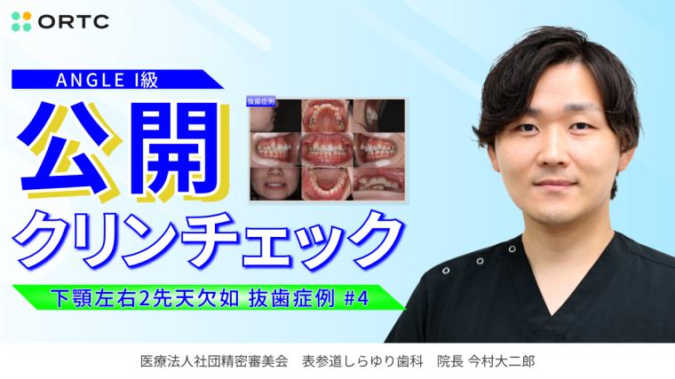 ANGLEI 級 下顎左右2先天欠如（抜歯症例） 今村 大二郎