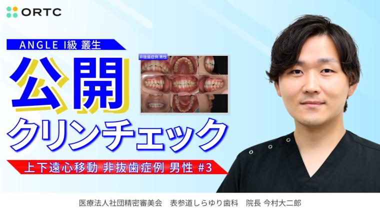 ANGLE　I級　叢生　上下遠心移動　非抜歯症例　男性 今村 大二郎