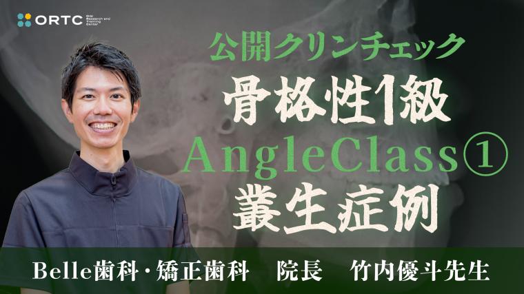 超シンプル！ファーストクリンチェックの7つのポイント　骨格性1級、AngleClass1、叢生症例 竹内優斗