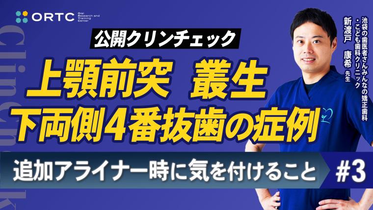 上顎前突、叢生、上下両側4番抜歯の症例、追加アライナー時に気を付けること3 新渡戸康希