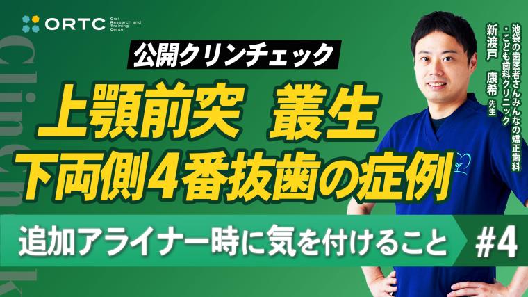 上顎前突、叢生、上下両側4番抜歯の症例、追加アライナー時に気を付けること4 新渡戸康希