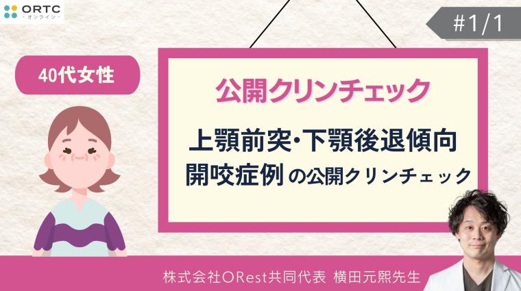 40代女性_上顎前突・下顎後退傾向・開咬症例の公開クリンチェック 横田元熙