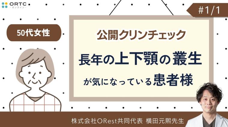 公開クリンチェック_50代女性・長年の上下顎の叢生が気になっている患者様 横田元熙