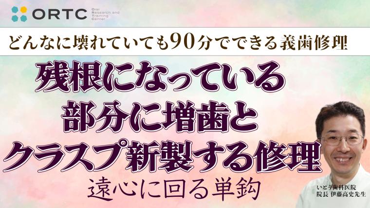 残根になっている部分に増歯とクラスプ新製する修理（遠心に回る単鈎） 伊藤高史