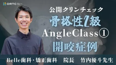 超シンプル！ファーストクリンチェックの7つのポイント　骨格性2級、AngleClass1、開咬症例