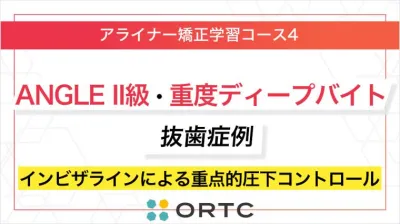 ANGLE II級・重度ディープバイト抜歯症例：インビザラインによる重点的圧下コントロール ORTCアライナー矯正学習コース４