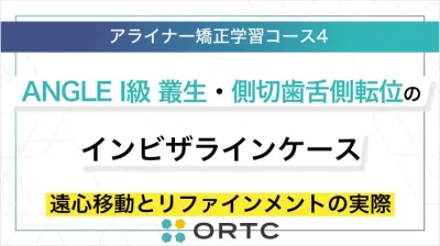 ANGLE I級 叢生・側切歯舌側転位のインビザラインケース：遠心移動とリファインメントの実際 ORTCアライナー矯正学習コース４