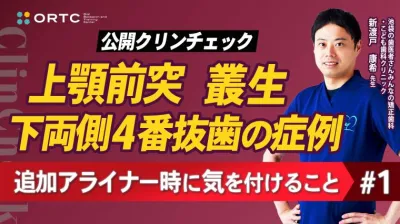 上顎前突、叢生、上下両側4番抜歯の症例、追加アライナー時に気を付けること1 新渡戸康希