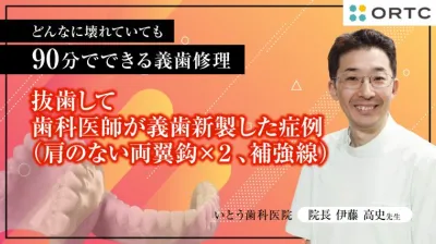 抜歯して歯科医師が義歯新製した症例（肩のない両翼鈎×２、補強線） 伊藤高史