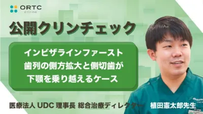 インビザラインファースト 歯列の側方拡大と側切歯の交差咬合（クロスバイト）改善