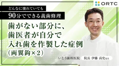 歯がない部分に、歯医者が自分で入れ歯を作製した症例（両翼鈎×２） 伊藤高史