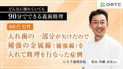 80代男性、入れ歯の一部分が欠けたので補強の金属線（補強線）を入れて修理を行なった症例